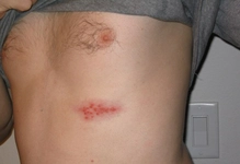 Zona Hastalığı Nedir?