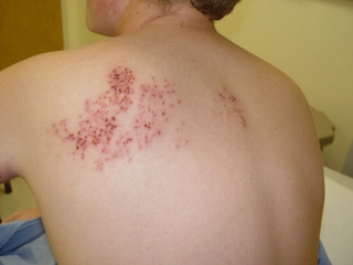 Zona Hastalığı Bulaşıcı mıdır??