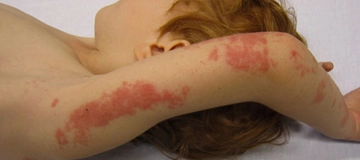 Zona İçin Şifalı Bitkiler Kullanımı ve Faydaları Nelerdir?